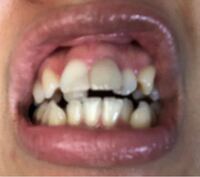 歯列矯正 ワイヤーかマウスピースか 迷いまくってます 奥歯 Yahoo 知恵袋