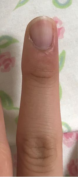ペンだこが酷いです 写真の通り ペンだこがとても大きくて 爪が曲がっ Yahoo 知恵袋