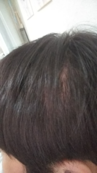 髪を切ったのですが 短くて頭皮が見えて ハゲっぽい といわれました髪って１日に Yahoo 知恵袋