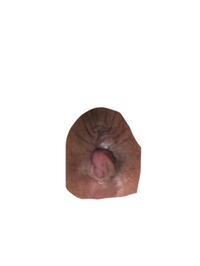 お見苦しい写真すいません おしりの穴の近くにこのような出来物がありま Yahoo 知恵袋