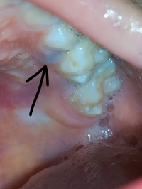 8歳男児 反対咬合で歯列矯正を始めるにあたって 青ゴムを左右上下 Yahoo 知恵袋