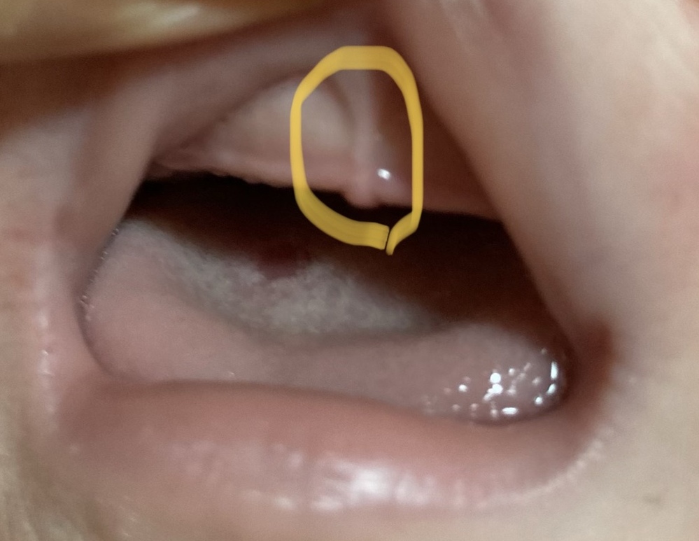 赤ちゃんの上唇小帯について 現在約10ヶ月の赤ちゃんです 下の歯 Yahoo 知恵袋