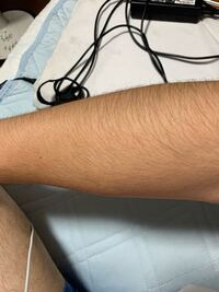 メンズリゼ脱毛するですけど 日焼け大丈夫ですかね Yahoo 知恵袋