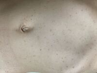 子供のお腹に黒い小さなシミのようなものが増えています 皮膚科に行きましたが Yahoo 知恵袋