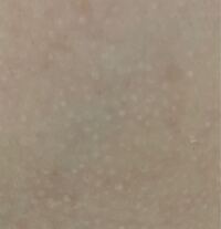 胸のあたりの広範囲にこのような白いポツポツ 常に白い鳥肌のようなものがあり Yahoo 知恵袋