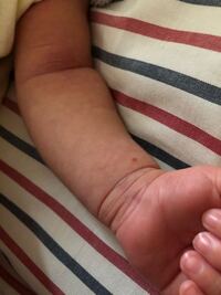 生後13日の子供です 腕や体などに数個ポツポツとあるのです Yahoo 知恵袋