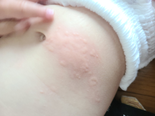 一歳の子供のお腹に虫刺されのような湿疹ができました これは Yahoo 知恵袋