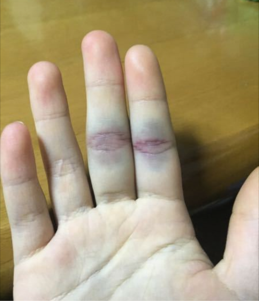 突き指 と 骨折 の 違い