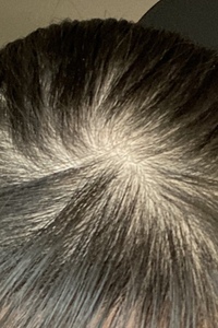 中学女子です 1年ほど前から分け目のハゲが目立ってきてしまい校則上髪を結わ Yahoo 知恵袋