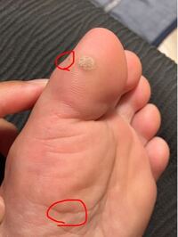 閲覧注意 足の裏のイボについてです 1年半くらい前から足 Yahoo 知恵袋