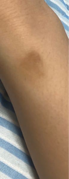 不正 苦難 今日 炎症 後 色素 沈着 クリーム Noisapositiveword Org