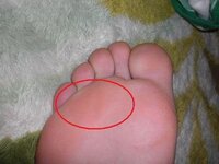 足の裏の打撲について 足の裏 写真の場所 を打ち しばらくしたら腫れて Yahoo 知恵袋