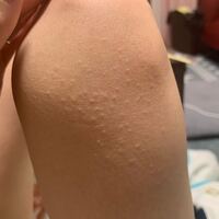 膝に小さいぶつぶつが出来たのですが これは何でしょう 痛くも痒く Yahoo 知恵袋