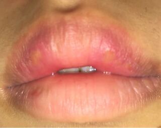 昨日からずっと上唇がヒリヒリするんですけど 今日起きたらもっと痛 Yahoo 知恵袋