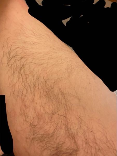 多毛症でしょうか 太腿から膝裏にかけての写真です 陰毛と同 Yahoo 知恵袋