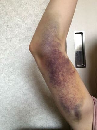 あざ 採血
