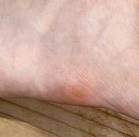 足の側面に水疱の集合体が出来ました 写真ではあまりわかりませんが 小さなブ Yahoo 知恵袋