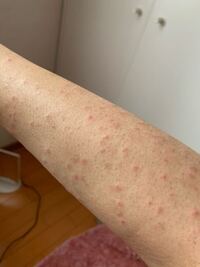 脱毛クリームで腕がかぶれてしまいました 一応 リンデロンvgを使って Yahoo 知恵袋