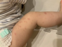 赤ちゃんのダニ対策 生後9ヶ月の息子がいます 一週間ほどまえ 朝起きたら顔と Yahoo 知恵袋