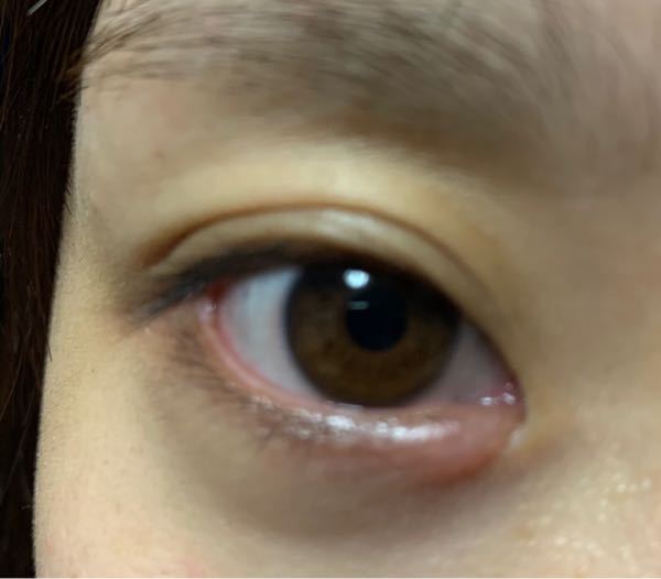 目頭に近いところが腫れてます 瞬きをすると下瞼のへこんでる骨が痛い気 Yahoo 知恵袋