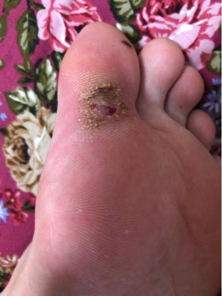 水虫 解決済みの質問 Yahoo 知恵袋