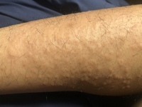 手足に痒いぶつぶつ手足に画像のようなぶつぶつができてとても痒いで Yahoo 知恵袋