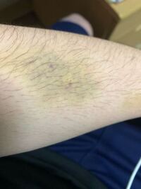 点滴についてです この間全身麻酔を行った際に点滴を行ったのですが失敗 Yahoo 知恵袋