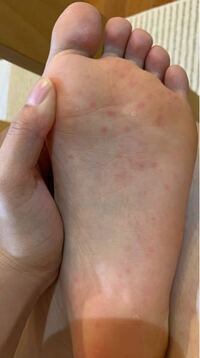 足の裏がこのような蕁麻疹が出ていて痒いです 同じようなことになったこ Yahoo 知恵袋
