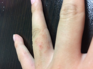 写真のように 一本の指だけ荒れていて 赤い斑点があります すごく痛いです Yahoo 知恵袋