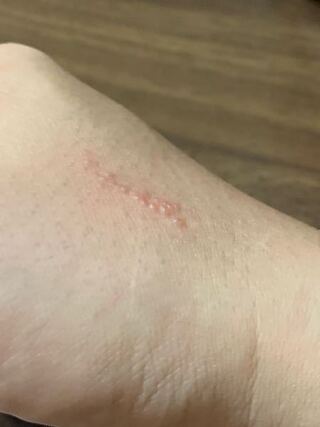 刺され 水ぶくれ 虫 子供
