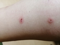虫刺され 両足が痒くて気づいたらこのような虫刺されのあと が合計10箇所く Yahoo 知恵袋