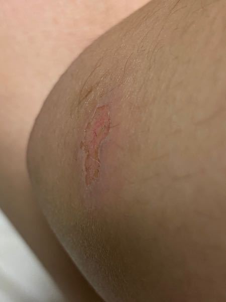 この傷が消える方法 閲覧注意ですバレーボールをやっていて 滑り込みで肘 Yahoo 知恵袋