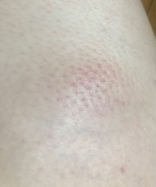 毛嚢炎 太もも に関するq A Yahoo 知恵袋