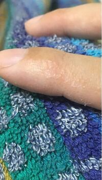 指に水疱のようなぶつぶつが出来ては皮膚が乾燥してひび割れ 剥がれ Yahoo 知恵袋
