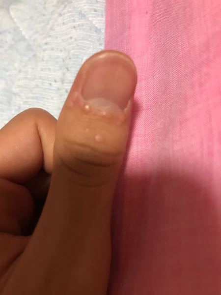 何ヶ月も前から指にいぼができているのですが、液体窒素での治療は一 