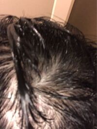 これはハゲてますか 頭がとても痒いです この時はリンスーをして髪 Yahoo 知恵袋