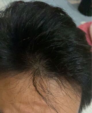前頭部の真ん中の生え際が髪が細く薄くなった気がするのですが どうでしょうか Yahoo 知恵袋