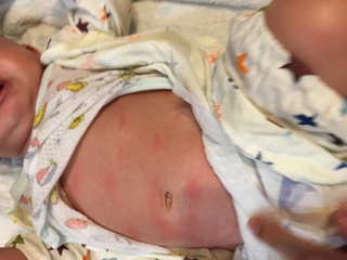 背中 湿疹 赤い お腹 赤ちゃん 赤ちゃんのお腹・背中に赤い湿疹が！あせもやアトピーの正しい対処【医師監修】