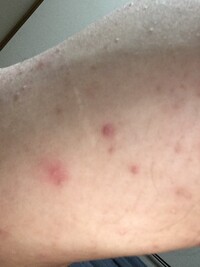 画像は前腕です 画像でわかるように ブツブツができてます 背中 胸腕全体に Yahoo 知恵袋