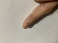 指のほくろについて質問です 歳の男性です 下の写真の通 Yahoo 知恵袋