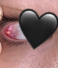 目尻側の目の中に白いできものができてたまに痛いのですがこれって霰 Yahoo 知恵袋