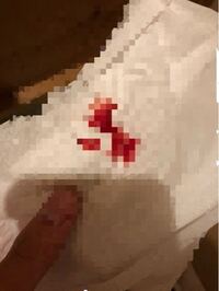 けつ拭いたら血がついたのですが 痔ですか 病院行ったほうが良いですか Yahoo 知恵袋