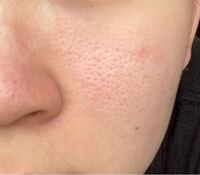 肌の汚い写真あるので閲覧注意です 私は現在18歳です 毛穴や角栓が顔 Yahoo 知恵袋