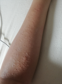 30分前くらいにいきなり腕が痒くなってしまいました 写真みたいになっ Yahoo 知恵袋