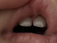 画像あり ホワイトスポット 乳歯について これは虫歯でしょ Yahoo 知恵袋