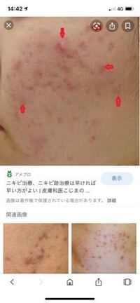 チョコラbbって肌の赤みを改善してくれますか 似たような写 Yahoo 知恵袋