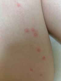 画像ありです 気付いたら気持ち悪いくらい虫刺されみたいなのができてました Yahoo 知恵袋