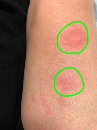 中心にふっくらとしたニキビではないですがニキビみたいな丸い点を中心に緑の範 Yahoo 知恵袋