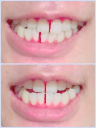 歯のズレと他人にどう見えているのかについての質問です 上の写真はなん Yahoo 知恵袋