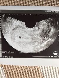 エコー写真について 今生理予定日からの計算で5週と3日です 2人目な Yahoo 知恵袋